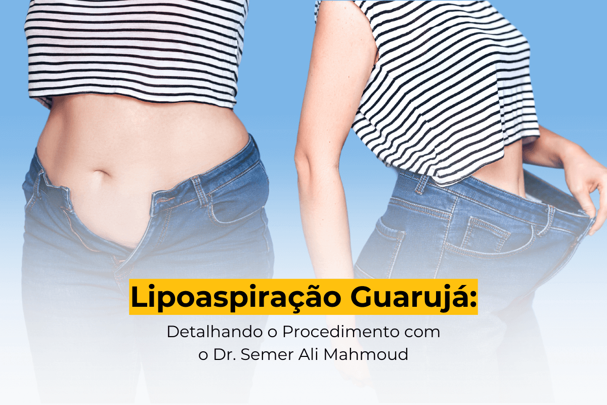 Lipoaspiração Guarujá: Detalhando o Procedimento com o Dr. Semer Ali Mahmoud