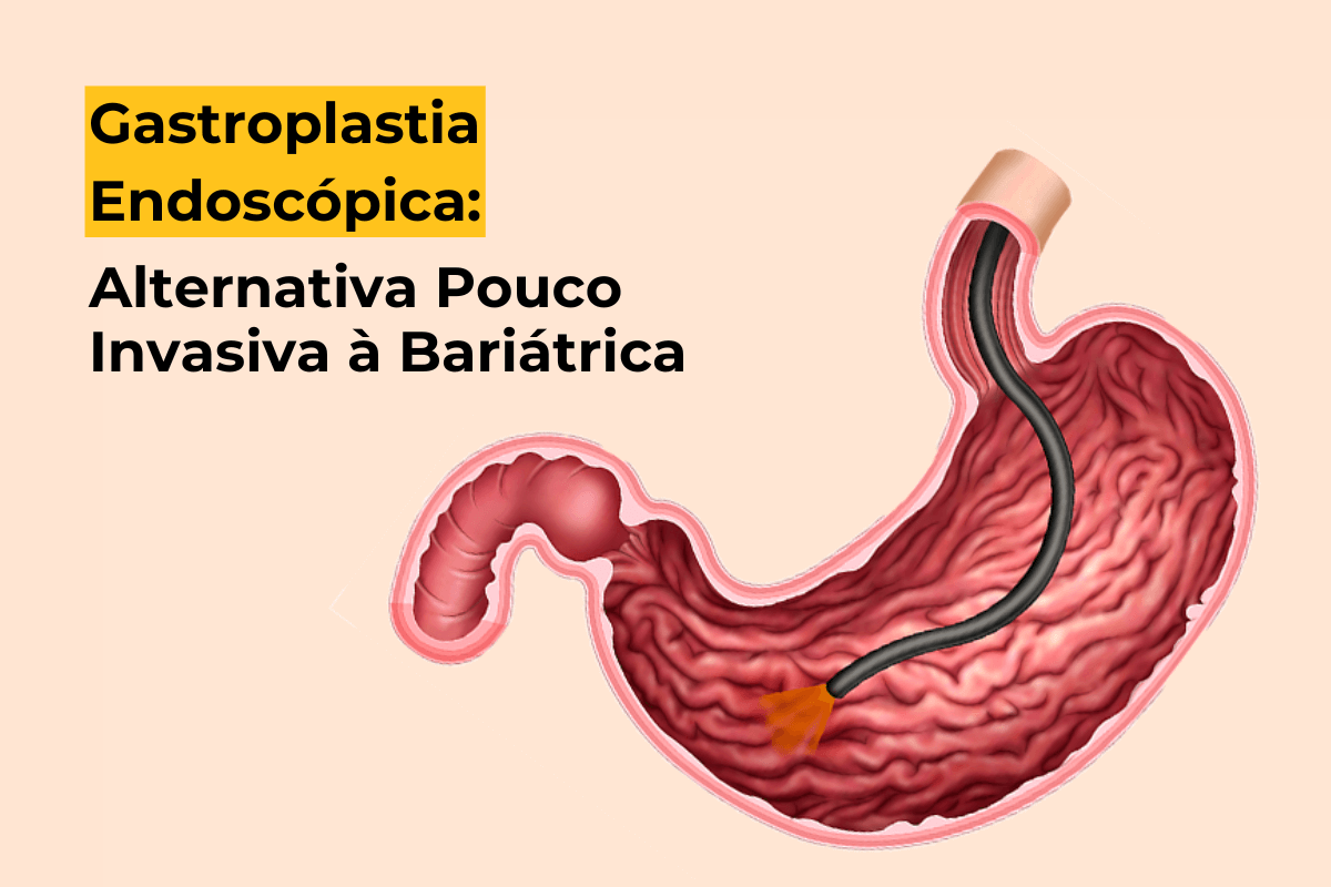 Gastroplastia Endoscópica em Maringá: Alternativa Pouco Invasiva à Bariátrica