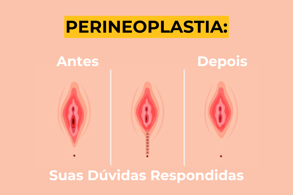 Perineoplastia em Maringá: Suas Dúvidas Respondidas
