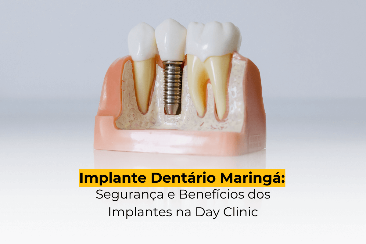 Implante Dentário Maringá: Segurança e Benefícios dos Implantes na Day Clinic