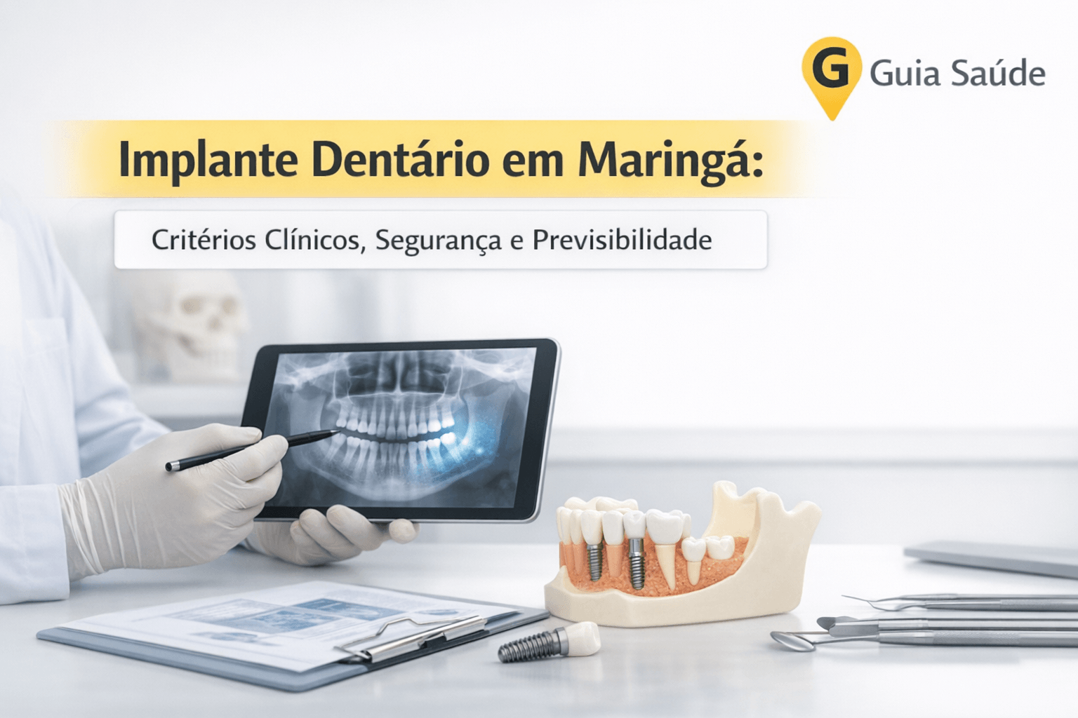 Implante Dentário em Maringá: Critérios Clínicos, Segurança e Previsibilidade