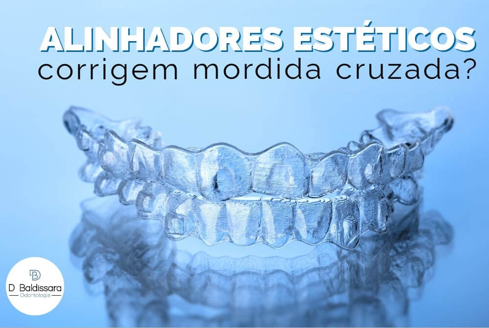 Alinhadores estéticos corrigem mordida cruzada?