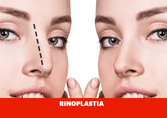 Rinoplastia