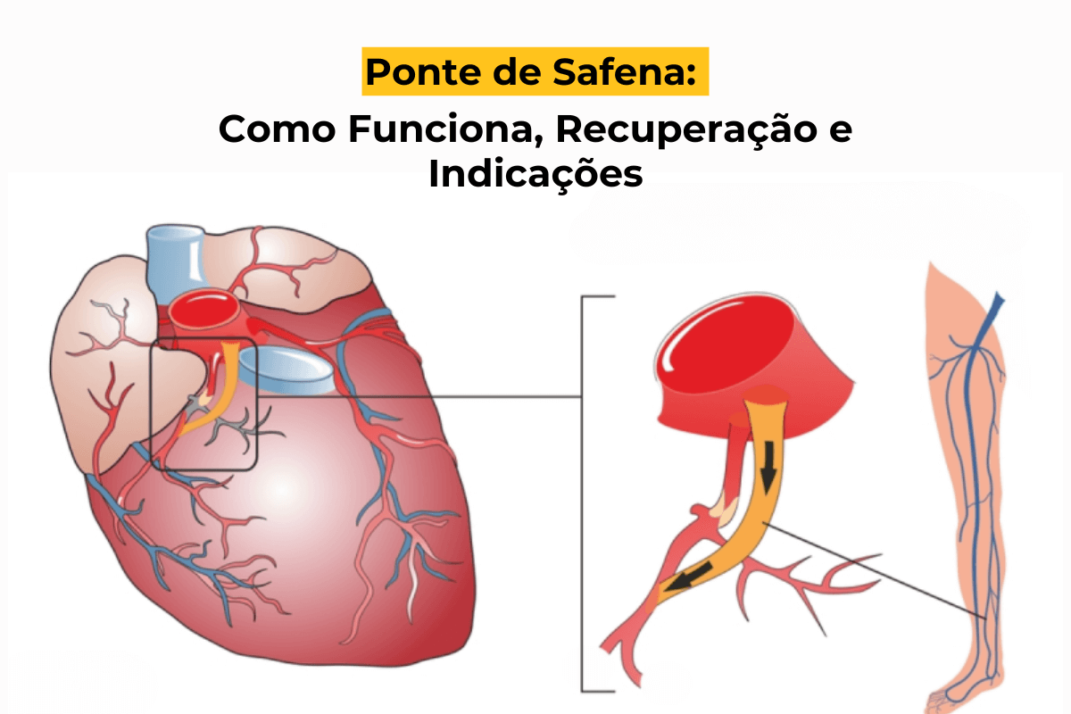 Ponte de Safena em Maringá: Como Funciona, Recuperação e Indicações