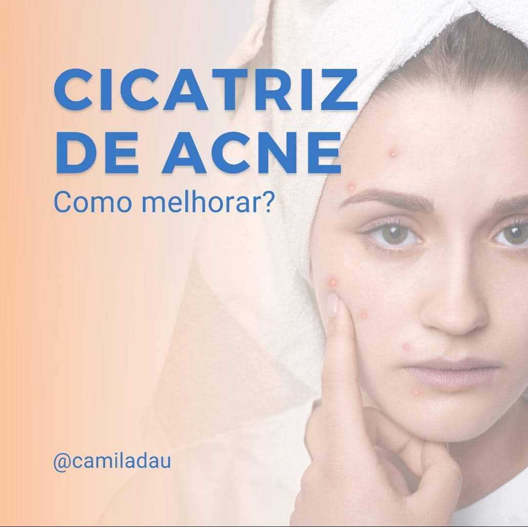 Cicatriz de Acne- Como melhorar?