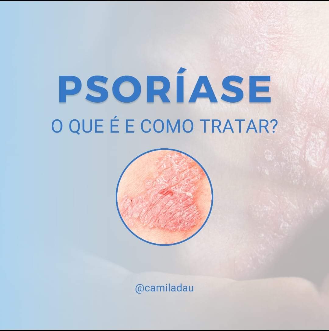 Psoríase - O que é e como Tratar?