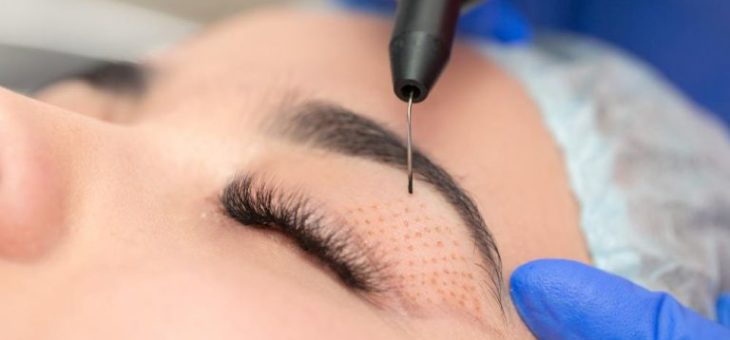 Segredos da Blefaroplastia a Laser em Maringá: Transformando os Seus Olhos