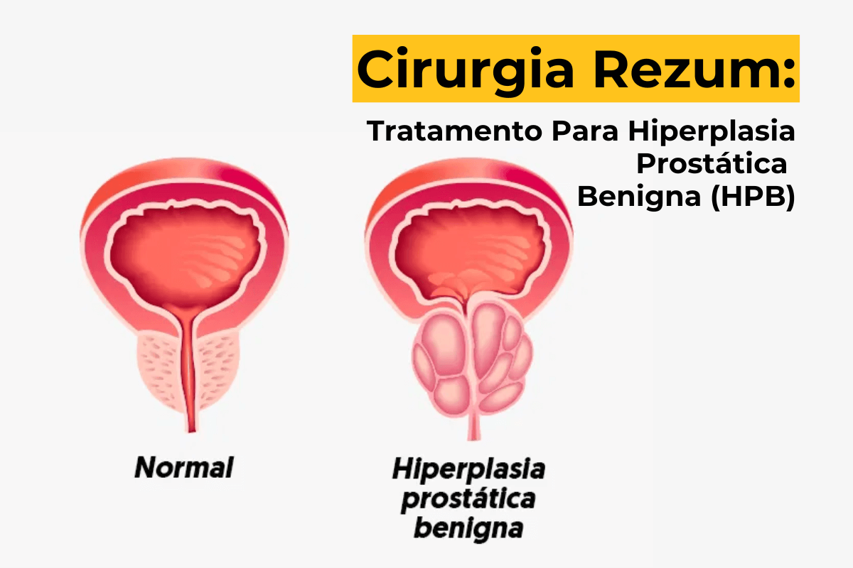 Cirurgia Rezum em Maringá: Tratamento Para Hiperplasia Prostática Benigna (HPB)