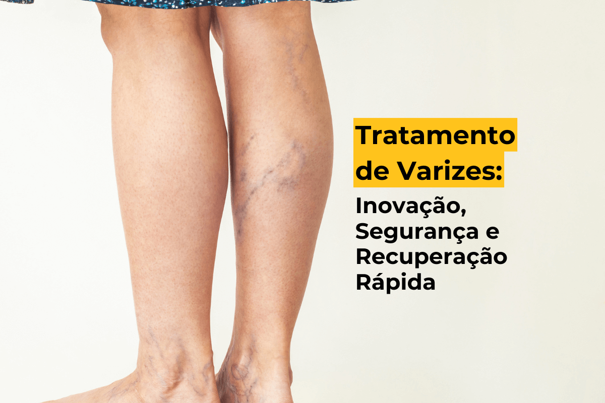 Tratamento de Varizes em Maringá: Inovação, Segurança e Recuperação Rápida