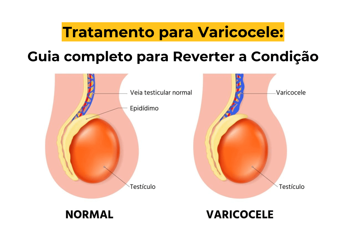 Tratamento para Varicocele em Umuarama: Guia Completo para Reverter a Condição