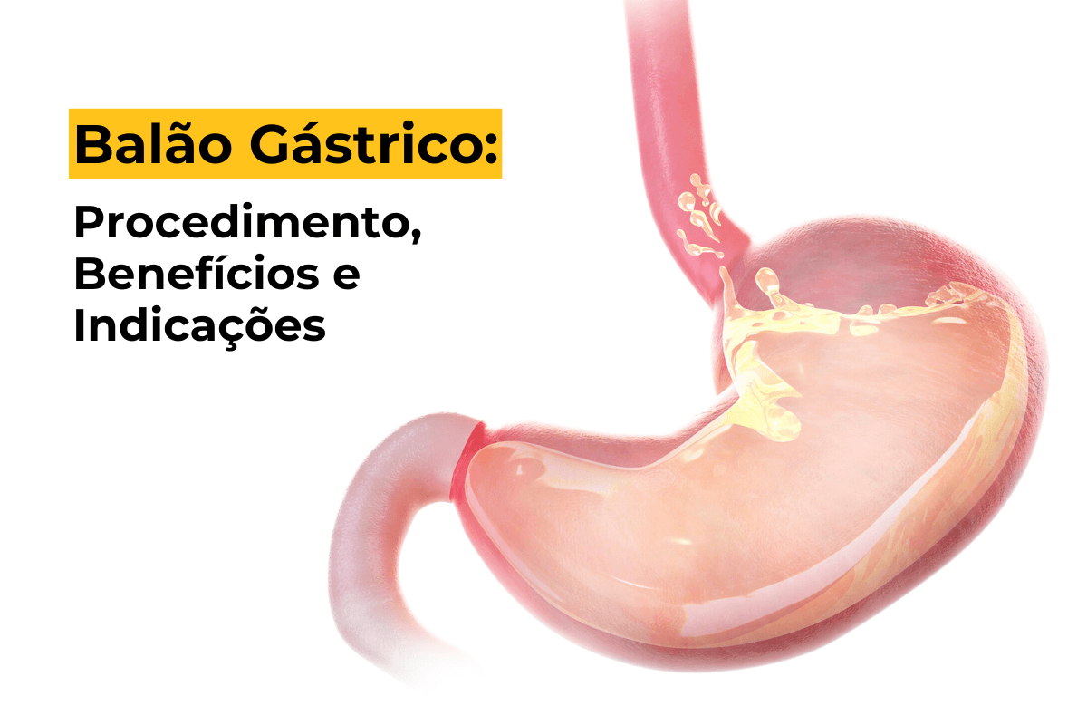 Balão Gástrico em Maringá: Procedimento, Benefícios e Indicações