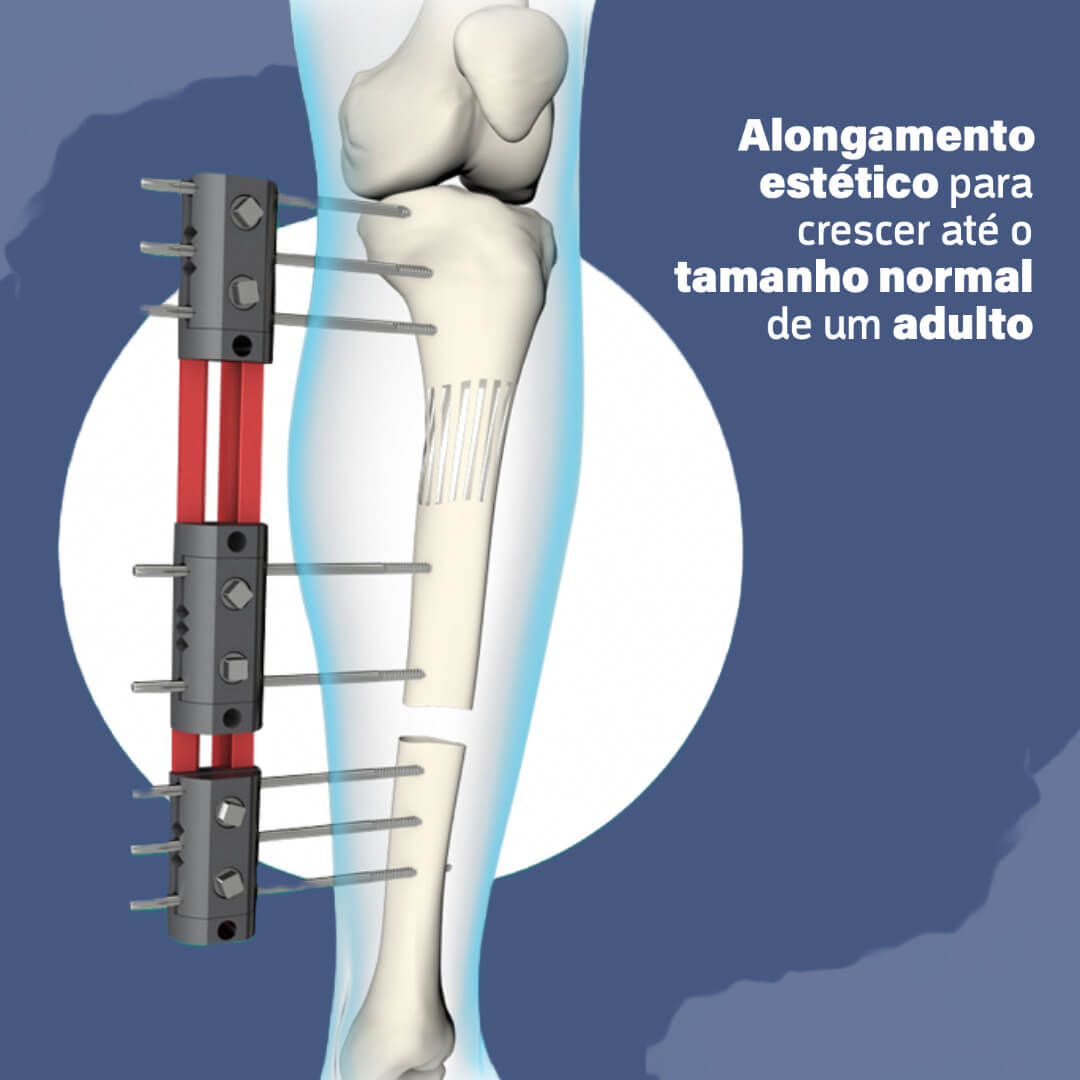 Alongamento estético para crescer até o tamanho normal de um adulto