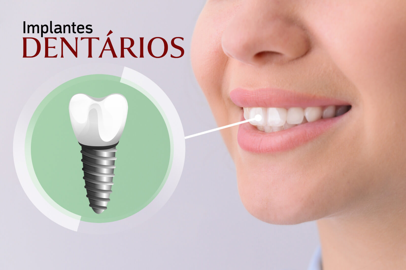 Implantes dentários