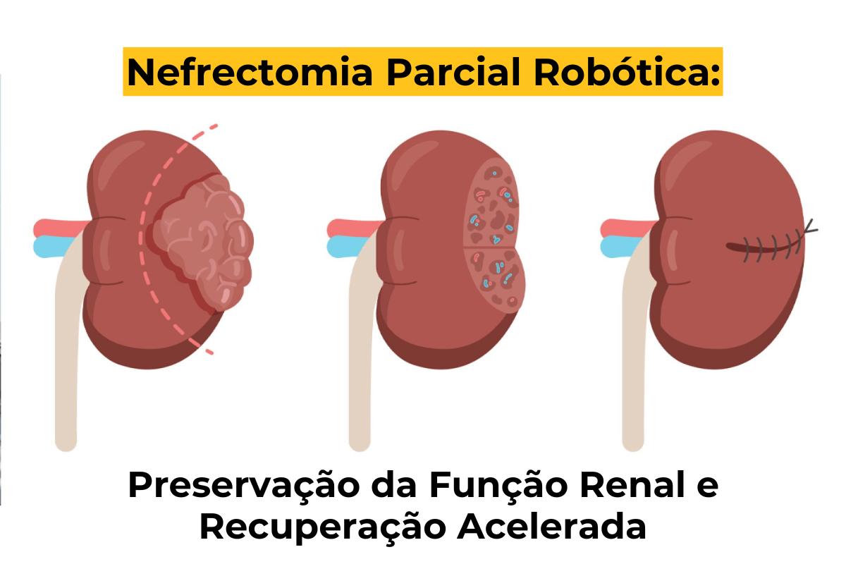 Nefrectomia Parcial Robótica em Maringá: Preservação da Função Renal e Recuperação Acelerada