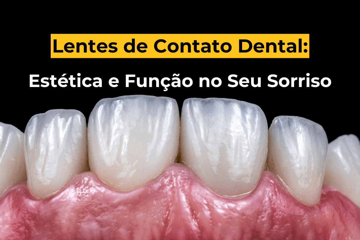 Lentes de Contato Dental em Maringá: Estética e Função no Seu Sorriso