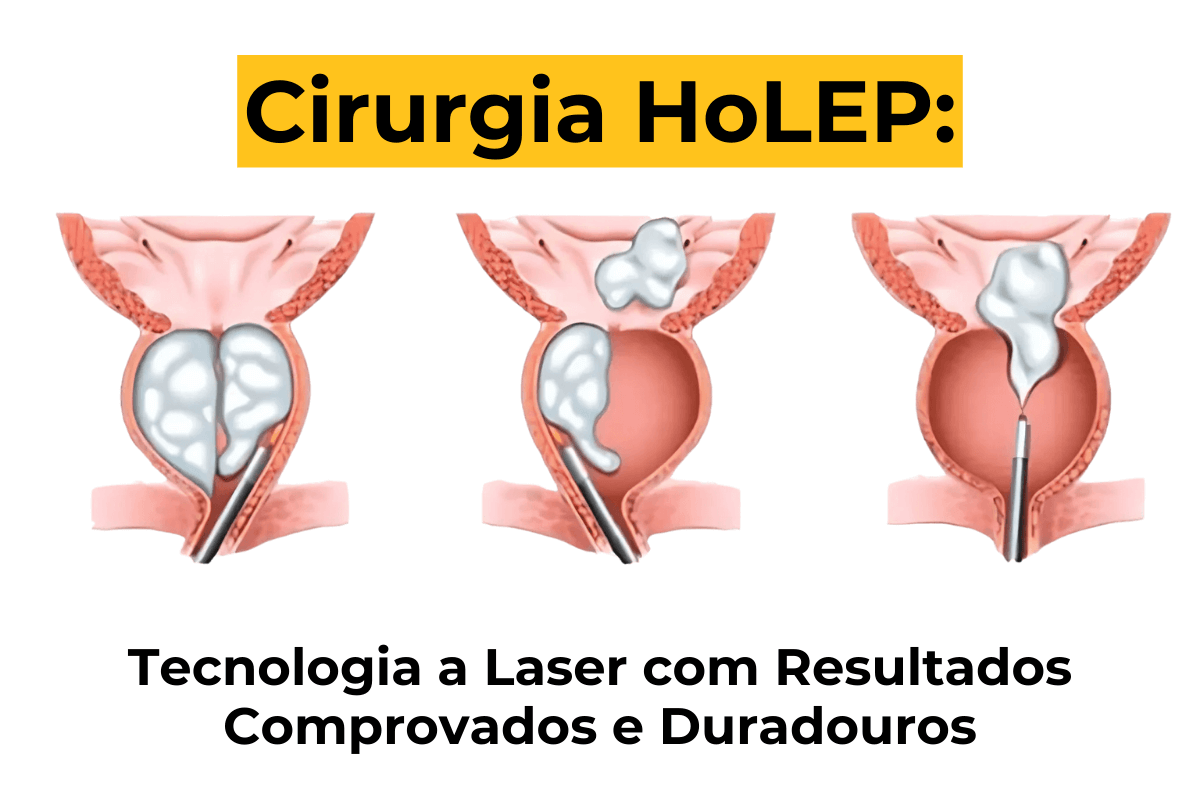Cirurgia HoLEP em Maringá: Tecnologia a Laser com Resultados Comprovados e Duradouros
