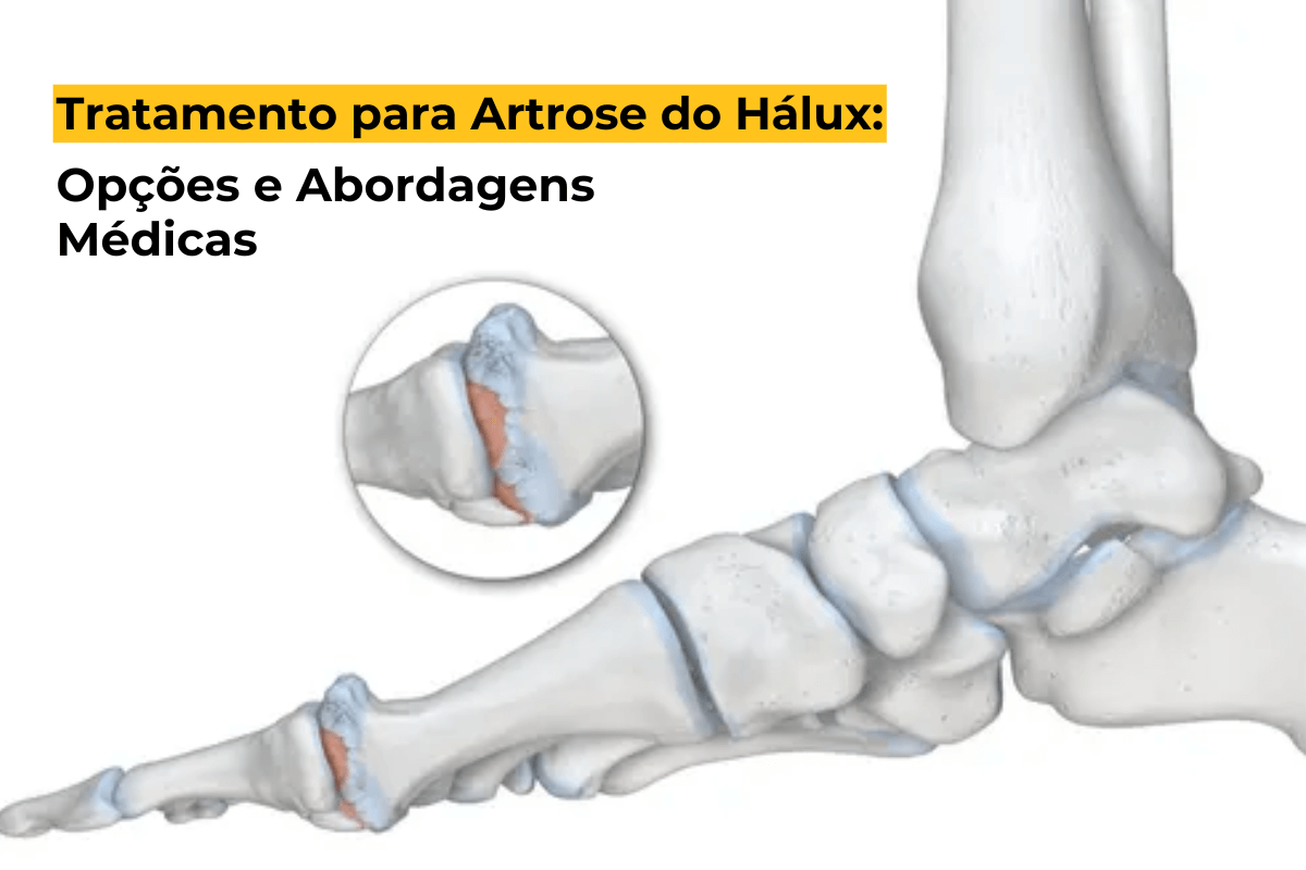 Tratamento para Artrose do Hálux em Curitiba: Opções e Abordagens Médicas