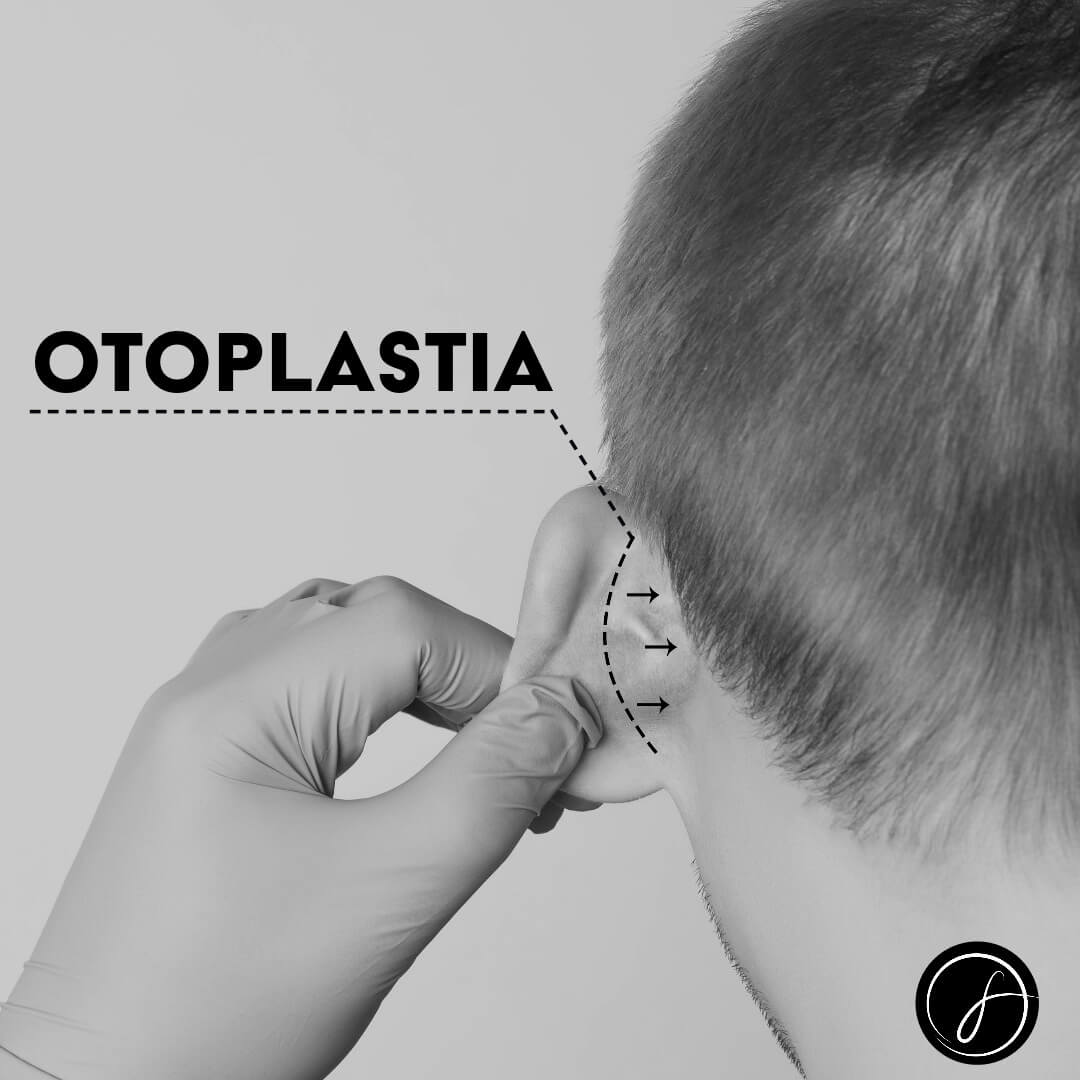 Otoplastia: Cirurgia para Correção das Orelhas de Abano e Suas Vantagens