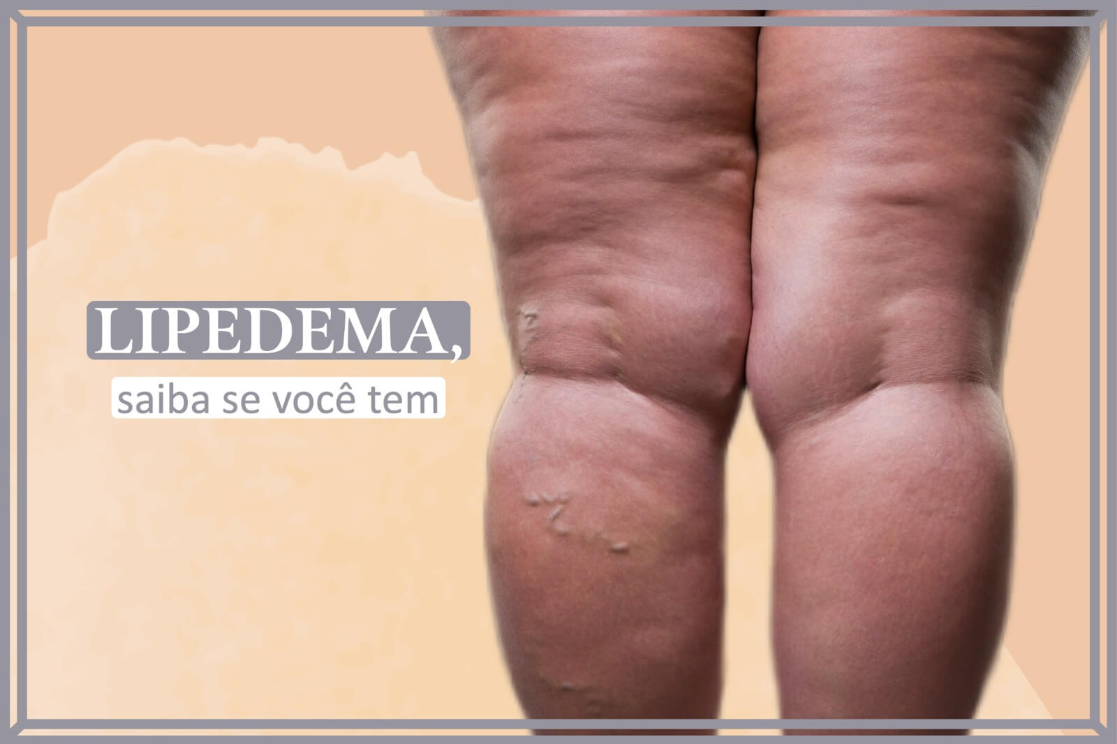 Lipedema: saiba se você tem