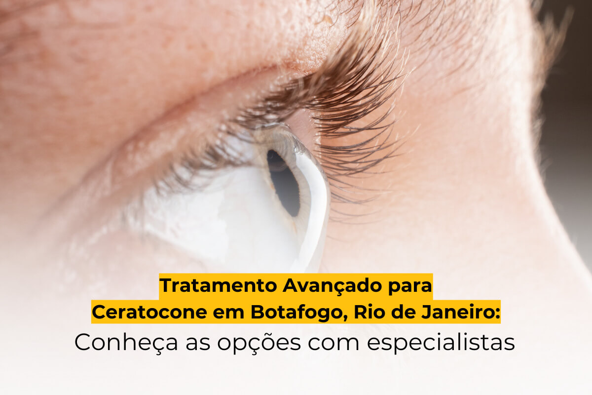 Tratamento Avançado para Ceratocone em Botafogo, Rio de Janeiro: Conheça as Opções com Especialistas