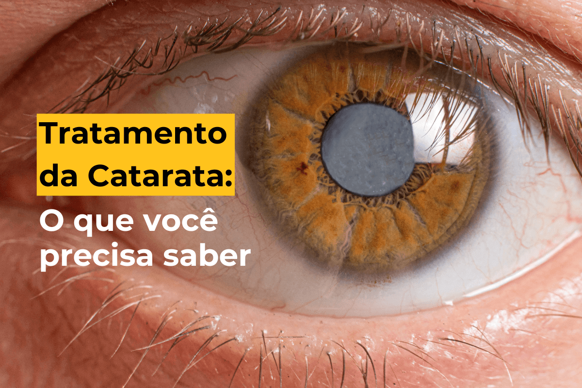 Tratamento da Catarata em Maringá: Procedimento, Recuperação e Tudo que Você Precisa Saber