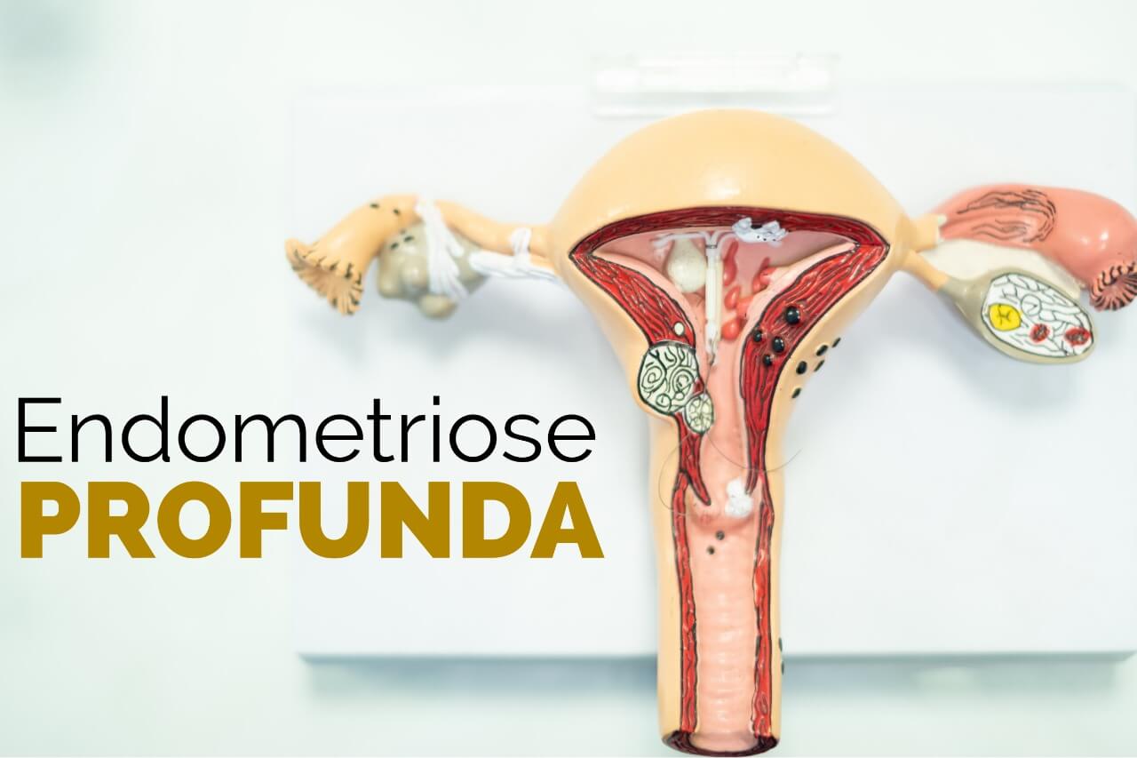 Endometriose profunda: Tudo o que você precisa saber.