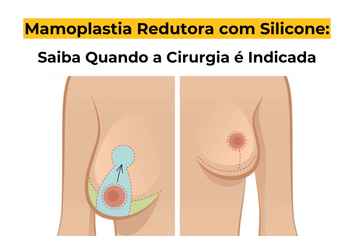 Mamoplastia Redutora com Silicone em Uberlândia: Saiba Quando a Cirurgia é Indicada