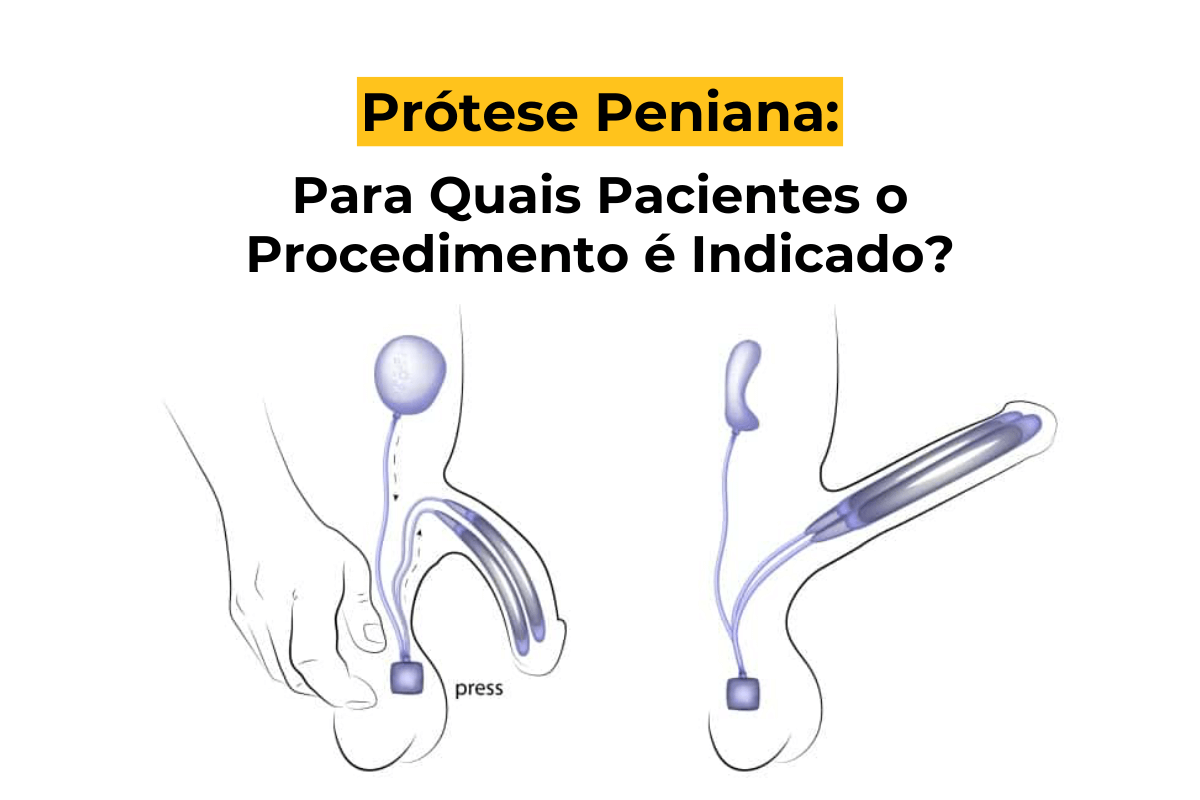 Prótese Peniana em Maringá: Para Quais Pacientes o Procedimento é Indicado?