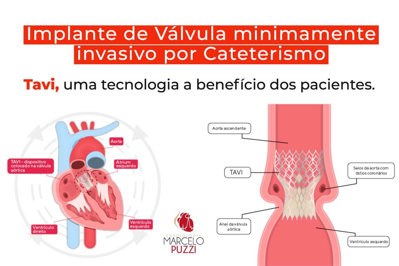 Implante de Válvula minimamente invasivo por Cateterismo - TAVI, uma tecnologia a benefício dos pacientes.
