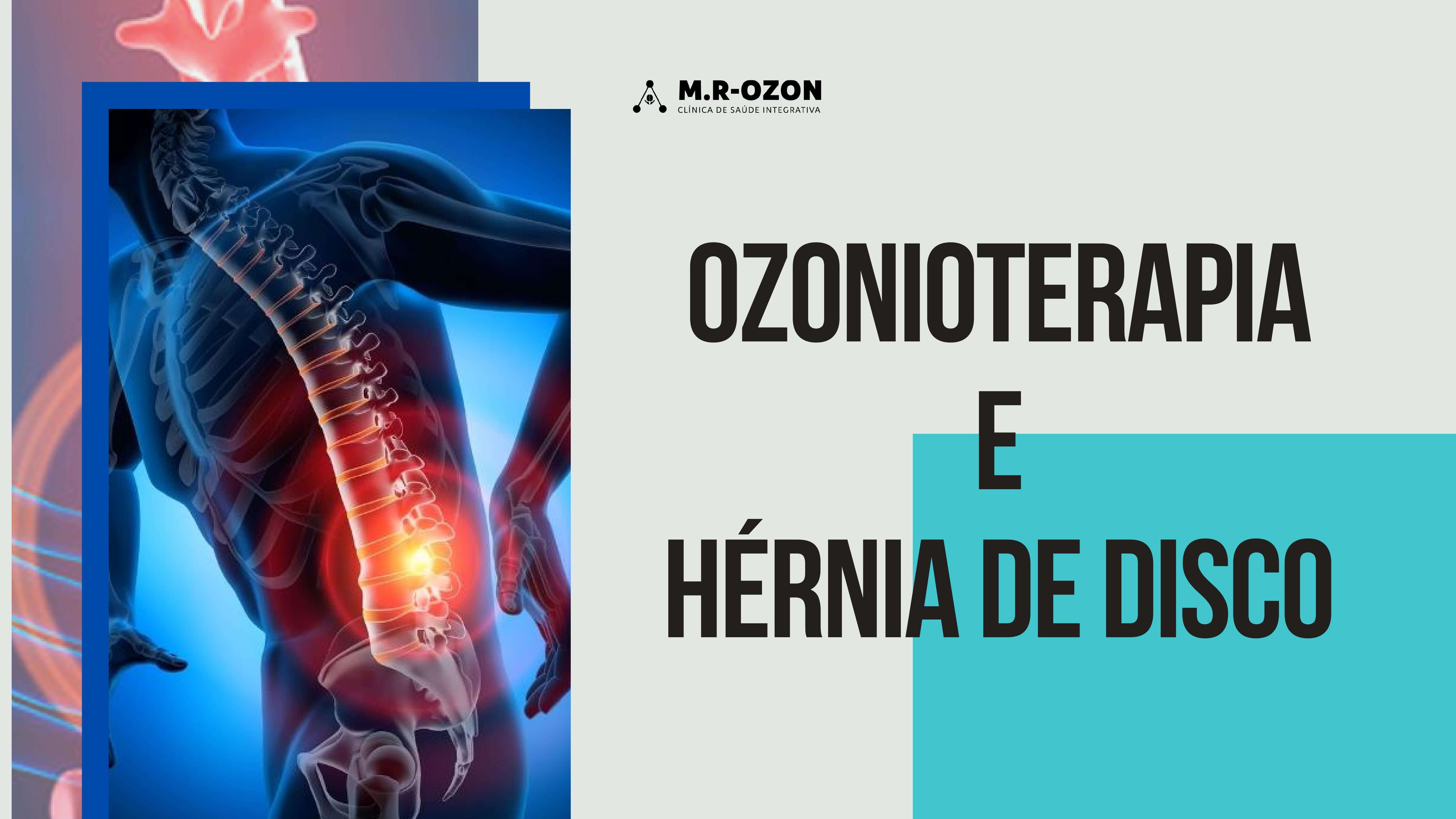 Ozonioterapia aliada no tratamento de hérnia de disco