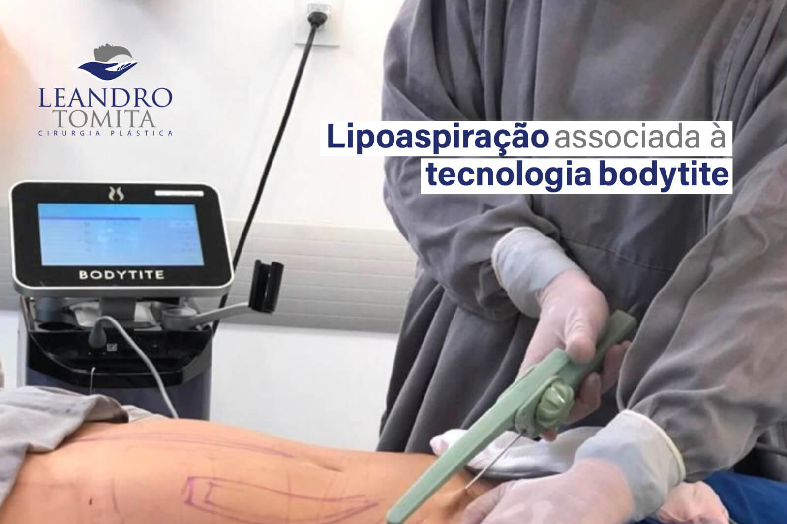 Lipoaspiração associada à tecnologia bodytite