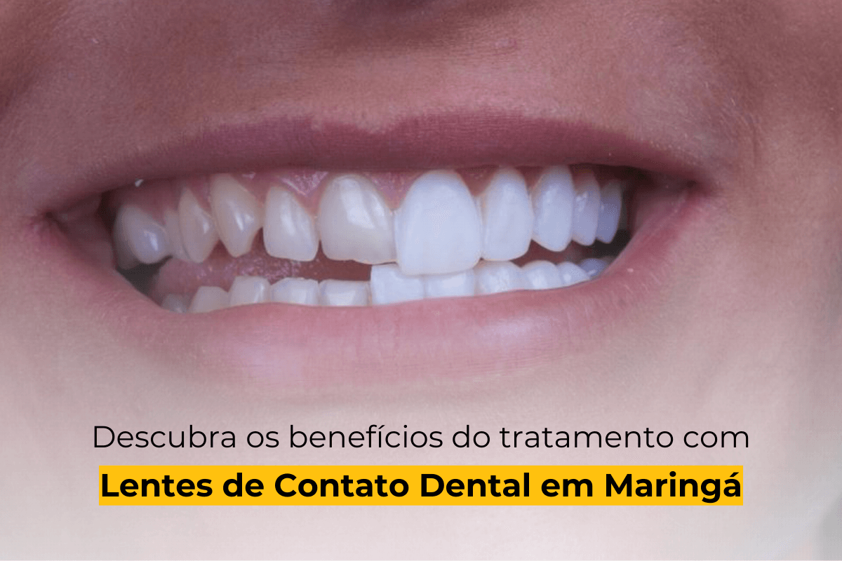 Descubra os Benefícios do Tratamento com Lentes de Contato Dental em Maringá