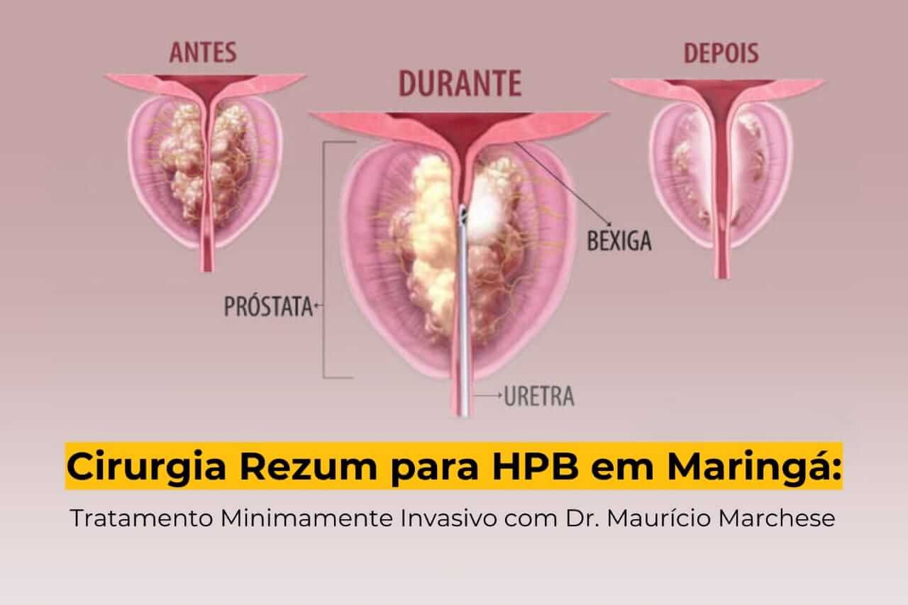 Cirurgia Rezum para HPB em Maringá: Tratamento Minimamente Invasivo com Dr. Maurício Marchese