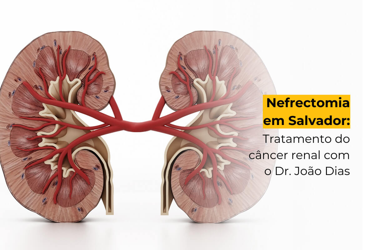 Nefrectomia em Salvador: Tratamento do Câncer Renal com o Dr. João Dias