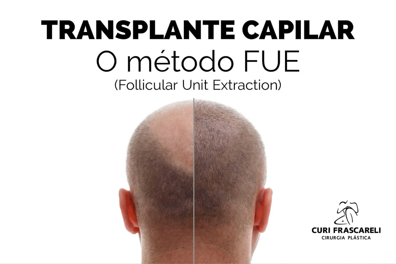 Transplante Capilar - O método FUE (Follicular Unit Extraction)