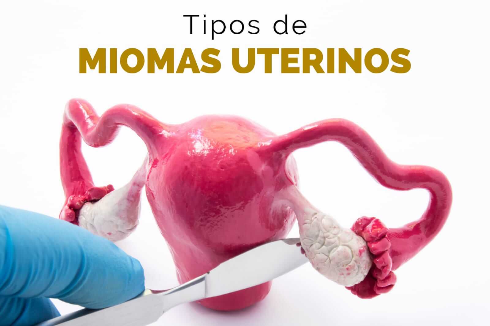 Tipos de Miomas Uterinos