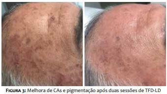 Terapia fotodinâmica com luz do dia: benefício clínico e estético com sessões repetidas para ceratoses actínicas faciais 