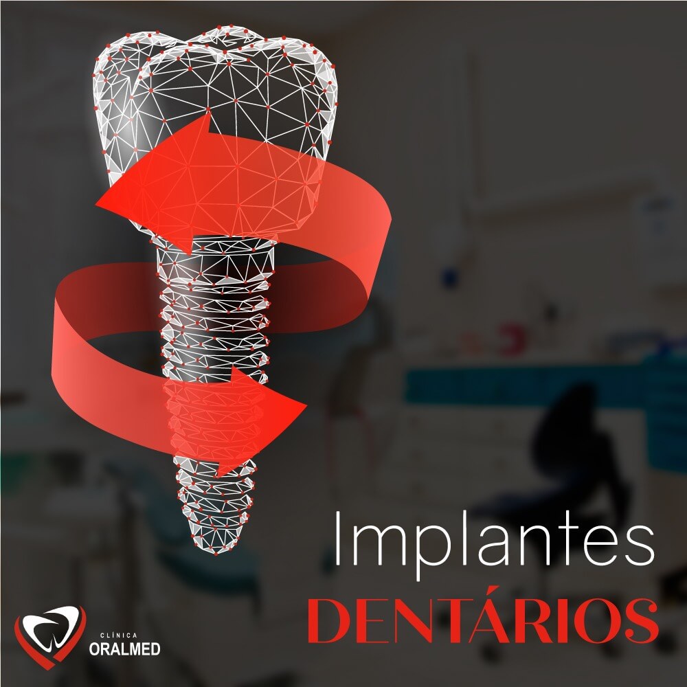 Saiba tudo sobre o tratamento de Implantes Dentários