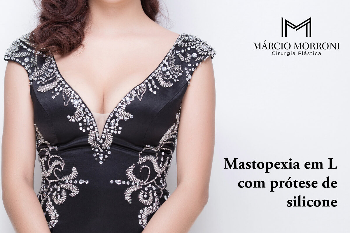 Mastopexia em L com prótese de silicone