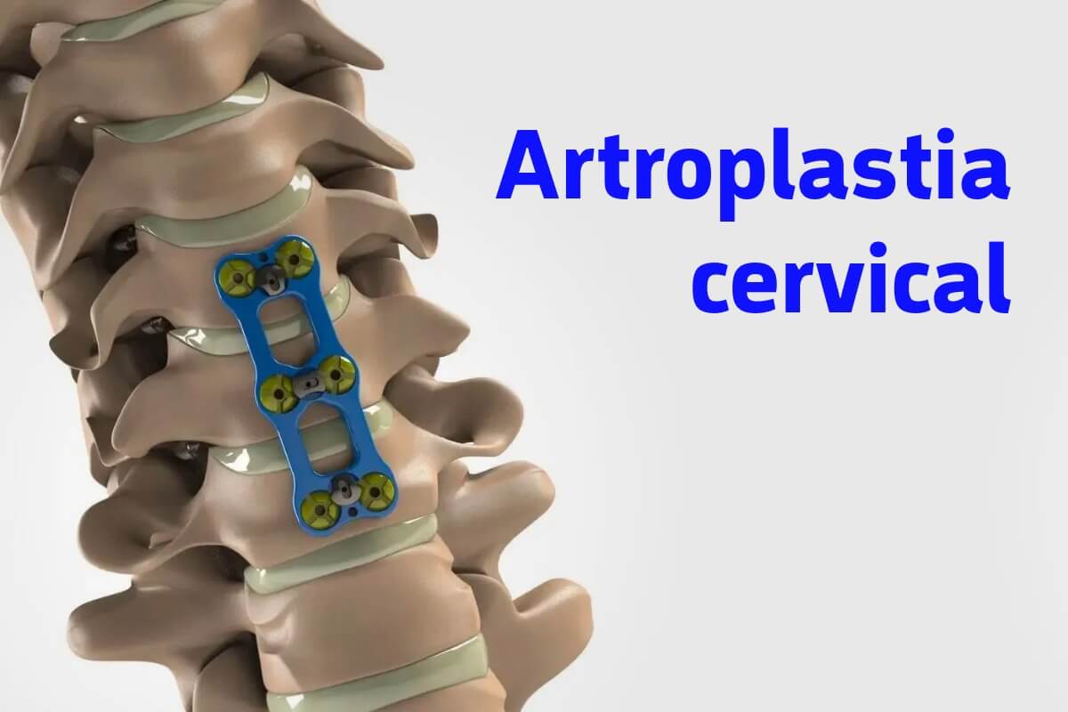 Artroplastia cervical