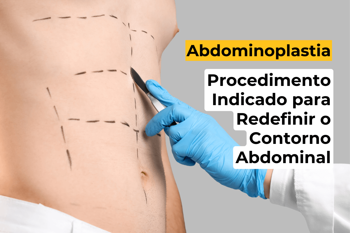 Abdominoplastia em Uberlândia: Procedimento Indicado para Redefinir o Contorno Abdominal