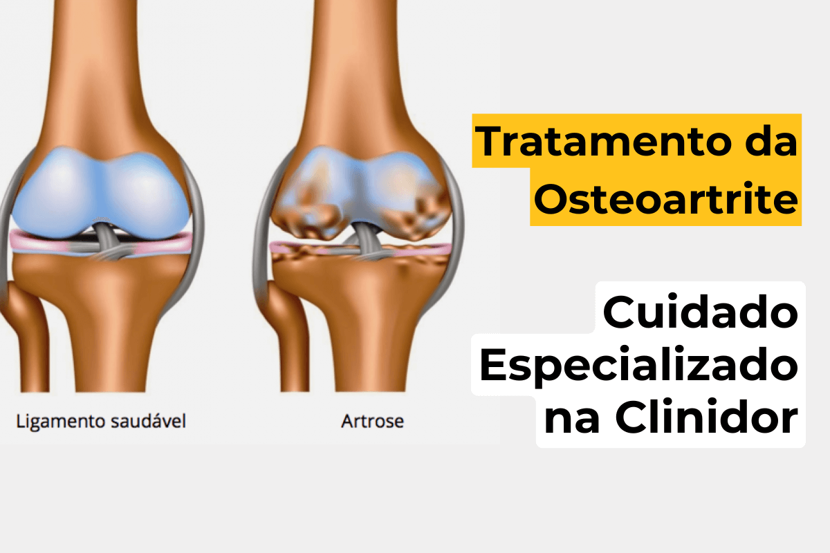 Tratamento da Osteoartrite em Maringá: Cuidado Especializado na Clinidor