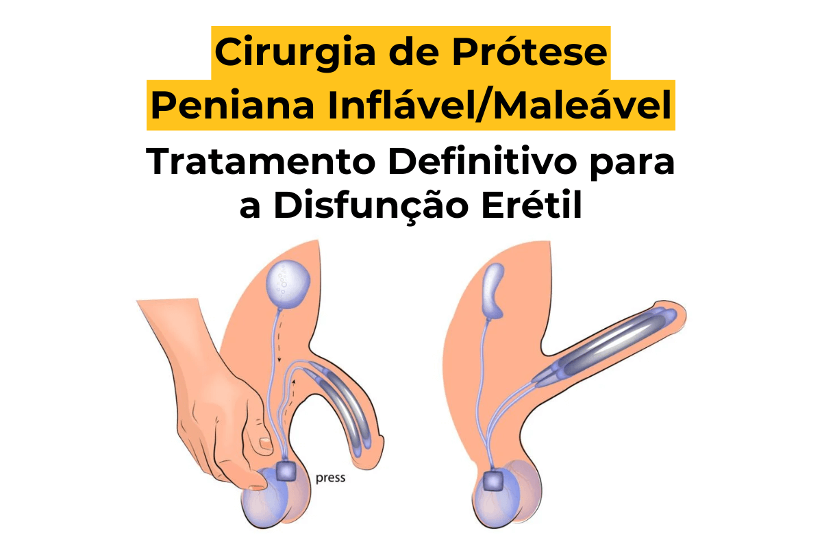 Cirurgia de Prótese Peniana Inflável/Maleável em Curitiba