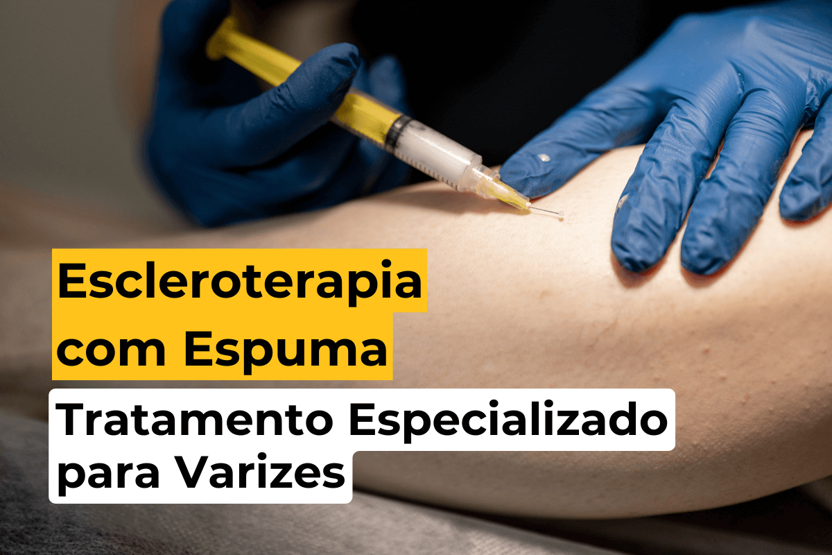 Escleroterapia com Espuma em Maringá: Tratamento Especializado para Varizes