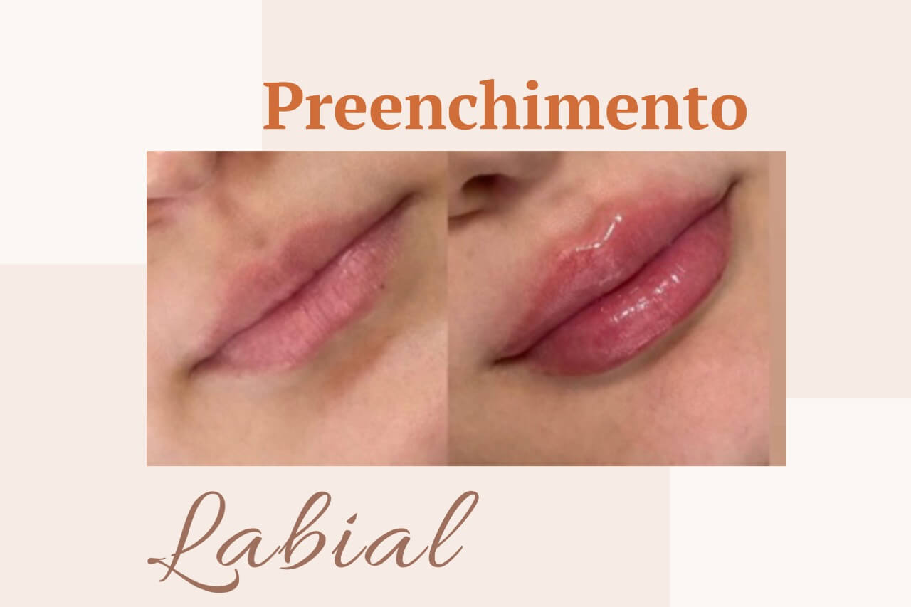 Preenchimento Labial