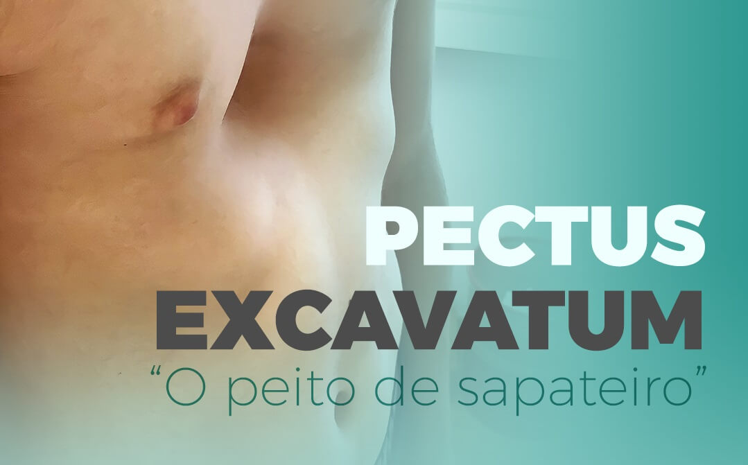 Pectus Exavatum 