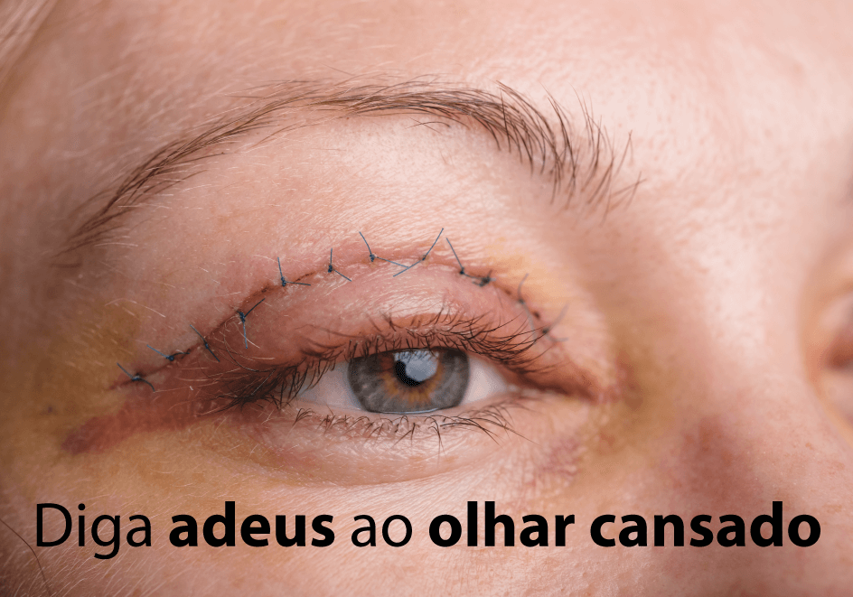 Diga adeus ao olhar cansado - Blefaroplastia