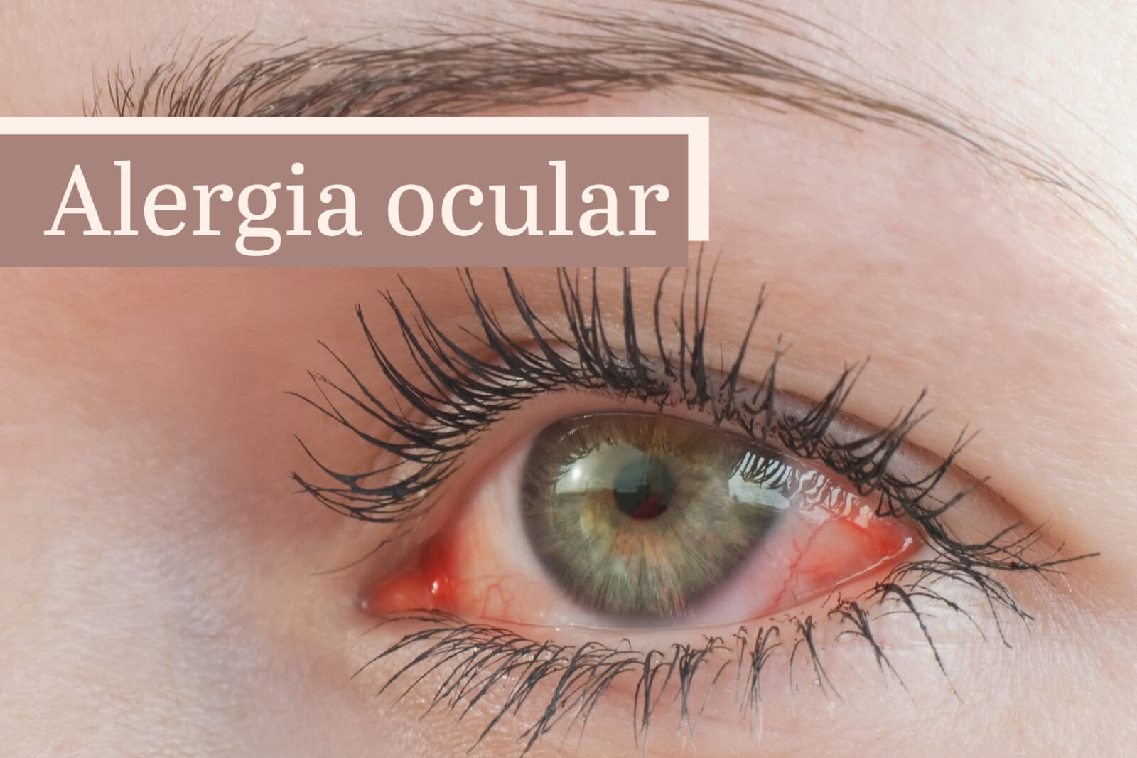 Alergia Ocular
