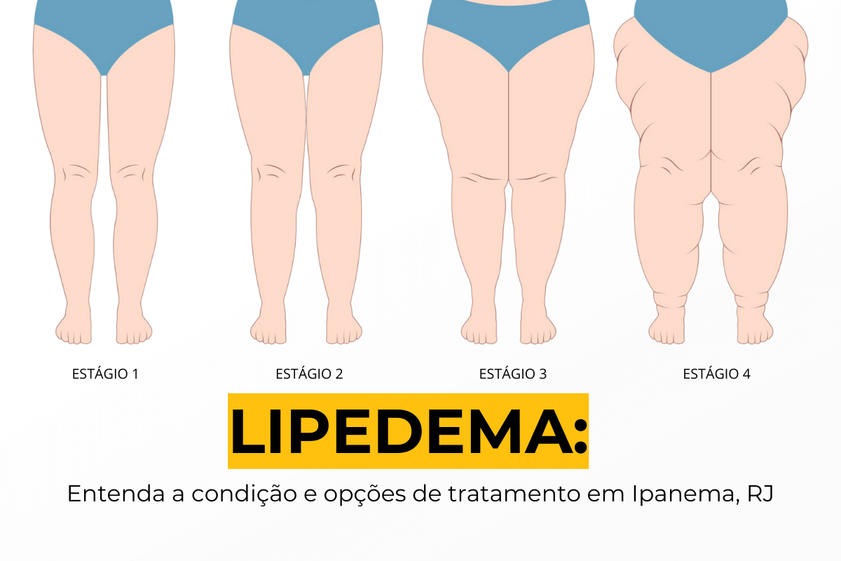 Lipedema: Entenda a Condição e Opções de Tratamento em Ipanema, RJ