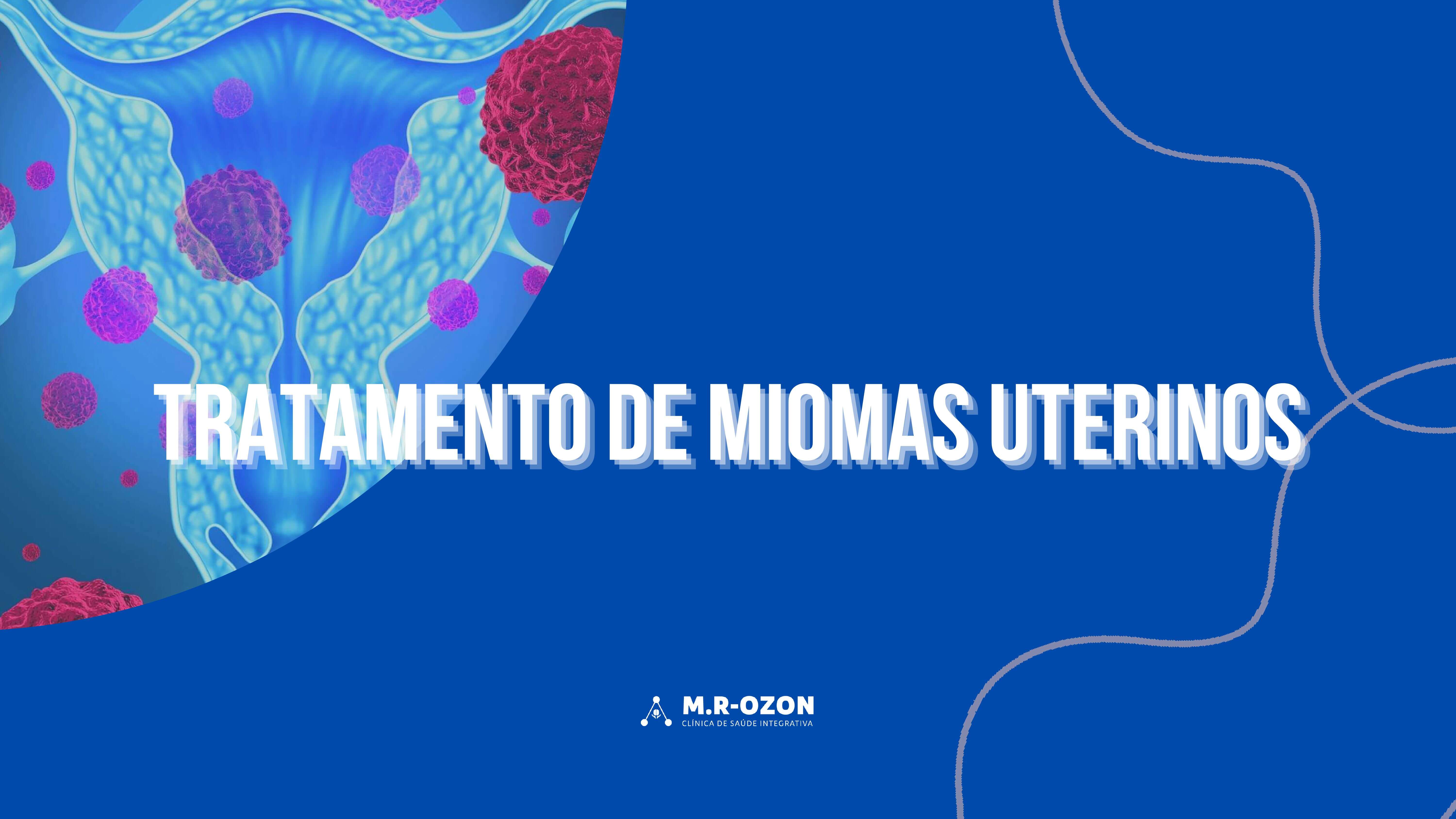Tratamento de miomas uterinos